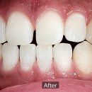 서울365스마일치과의원 | 🦷 [치아미백 전후 비교] 단 2회로 완성된 화이트 스마일 – 365보스턴치과