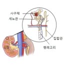 급성 간질성 신염 (Acute tubulo-interstitial nephritis) 신장 비뇨기 질환이란? 이미지