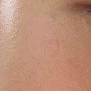 더블유엘비에프 | 압구정 루비레이저,C02레이저,리팟레이저 시술 후기 2틸(7일차, 3주차, 한달 후, 추천,비추천시술)