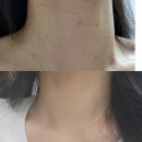 이유한의원 | 강남역 한의원 목 편평사마귀 생기는이유 아인침 제거 후기 가격 내돈내산