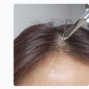 한국화학연구원 연구원노동조합 | 여성도 M자 탈모가 올 수 있을까?“풍성해지는 느낌이에요” 실제 후기에서 본 변화