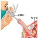 방광암의 진단 방법 이미지