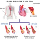 노년기 심근경색 질환에 대하여 알아봅니다. 이미지