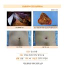 담낭제거수술후. 담낭폴립 1.2cm 진단을 받은 후 대학병원 두 곳과 튼튼병원 김정윤 원장님 진료를 받았습니다. 이미지