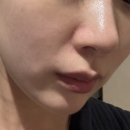 라보떼 | 강남 신논현역 피부과의원 글리쥬 라보떼 스킨부스터 후기