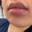 강남테라성형외과의원 | [경기/부천 원미구] 입술필러와 이마필러 맛집 <강남테라성형외과>