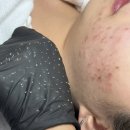 다드림약국 | 사춘기성 여드름이 이마부터 생기는 이유 6가지 - 서울대피부관리 (다드림피부연구소)