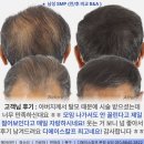 디에이헤어 - 은평구 진흥로 267-16 | 대구헤어라인문신 SMP 헤어 라인 정말 중요해요