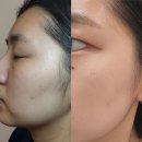 모자한의원 | 명동 얼굴편평사마귀 성지 한의원 레이저없이 무제한 제거 후기 듀오덤없이 시술 후 관리 팁까지