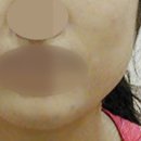 고운님여성의원 | 용인 보톡스, 사각턱 문제가 있던 환자 후기