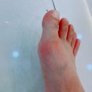 일성약국 | 통풍증상 의심되면 참지말고 병원가세요 - 정형외과 진료후기
