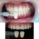 보스톤미소치과의원 | 의정부 보스톤미소치과 교정 후 깨진 앞니 두 개, 라미네이트로