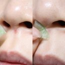 티.디.에스 | 여드름 없애는법,에슬(essl) 유산균 트러블 케어 세트 3일 집중관리 후기