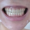동그라미치과의원 | 잠실치과 :: 30대 치아교정기장치 제거, 교정기간 상세후기