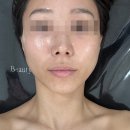 5773 | [관리] 대전 봉명동 엘라뷰티 본점 리프팅 관리 후기 / 대전 신부관리 추천