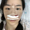 노블캣 | 강남 이비인후과 코성형 귀족수술 후기