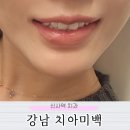한양치과의원 | 강남치아미백 신사역 레브치과의원 전후 비교