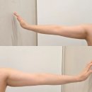 구월동 지방분해주사 | 예비신부의 고민! 팔뚝 제로컷주사 2회차 솔직후기♪(사진有)