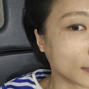 라인인 | 광주아이라인제거 큐오필 후기 쌩얼 자신감 되찾기 통증, 붓기, 효과 솔직정리