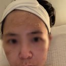 출산 후 산후 피부관리 고민해결!(편평사마귀 박멸 프로젝트) 혐오 사진 주의 _내돈내산후기