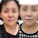홍대피부과 미희주사 엄마 팔자주름 채운 후기 (효과 및 가격, 통증)