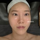 [부산/하단동피부관리] 퓨어스킨앤바디 하단점_하이푸+물방울리프팅 후기 #얼굴라인정리