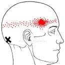 근육학(MPS) 관련 그림 & 동영상 : 두반극근(Semispinalis Capitis) 발통점(Trigger Points) 이미지