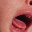 연세우리동네의원 | 아기 신생아 설소대 시술 후기 (연세사랑소아청소년과, 다산 진소아과)