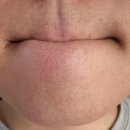 데이샤인의원 | [데이샤인의원 병점] 남자 수염 제모 3회차 후기