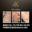 센텀연의원 | 부산 통증없이 기미제거 색소침착 홍조, 미백 관리 _ 비비엘히어로 올인원 치료