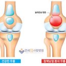 복숭아뼈 부음 원인 통증 물혹 점액낭염 이미지