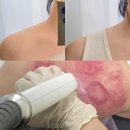 거성메디칼 | 오산거북목관리 뱀부 마사지 승모근 굳은 라인 케어 후기