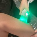 샤인멍 | 강남피부과 바디인모드 500샷 팔뚝 샤인모드 통증 멍 이벤트가 후기