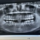 금마운수 | 치아교정 중 매복 사랑니 뺀 후기(드라이소켓)