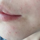 연재스킨케어 | [긴급] 접촉성 피부염으로 뒤집어진 얼굴, 원인 찾고 셀프처방 (엑소좀 MTS 예약)