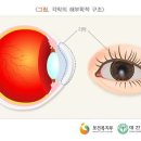 각막 레이저 광응고술[Corneal laser photocoagulation ] 이미지