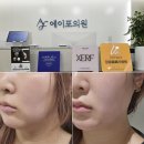압구정 온다리프팅 이중턱레이저 효과 좋네 에이포의원 후기