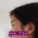 검버섯 없애는 법, 흑자 제거 완료! 치료 비용 대전 피부과 찐후기