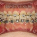 예쁜치아만들기치과의원 | 아래턱이 큰 돌출입, 뼈 공간을 이용한 후방이동 비발치 교정 전후 후기. 잠실 치아교정