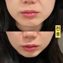 오케이약국(OK약국) | 대구수성구피부과 리프팅 레이저 세르프 300샷 리얼후기