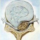 요추디스크병변{추간판수액탈출증(Herniated nucleus pulpose)} 이미지