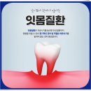 [공지] 포곡 치과, 잇몸 부어오름 등 불편함이 있으신 분들 주목하세요!