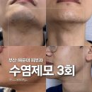 3플러스 | 해운대피부과 남자제모효과 대박! 젠틀맥스프로플러스 3회차 후기