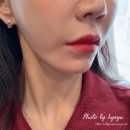 포레스트멍 | 포레스트리프팅 후기 마리오네트 입가 고민으로 다녀왔어요