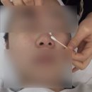 필아쿠아 | [대구] 미소에스테틱 아쿠아필 진정 관리 후기 ✨💍