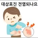 대상포진 전염되나요 이미지