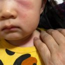 아토앤맘소아청소년과의원 | 아이 아토피치료 후기(스테로이드 연고, 아토피 아이 우유, 내돈내산 로션크림 추천)