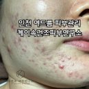 인천 간석동 케이속건조피부연구소 누르면 아픈 여드름 피부관리 후기