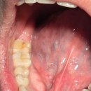 상쾌한유완진치과의원 | 20260213 미니쉬 MINISH치과병원 oneday 어금니...3년만에 쓰는 미니쉬 후기, 매년 점검,미니쉬...