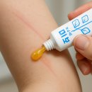 미보약국 | 화상연고 추천, 팔 데였을 때 ‘화상엔 미보’ 사용 후기